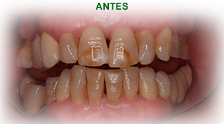 Estetica Dental Antes del tratamiento