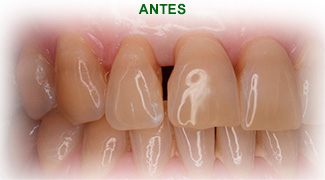 Estetica Dental Antes del tratamiento