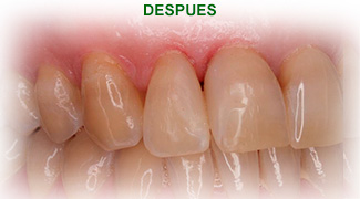 Estetica Dental Tras del tratamiento