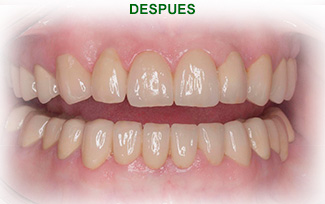 Estetica Dental Tras del tratamiento