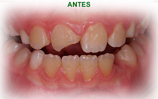 Estetica Dental Antes del tratamiento