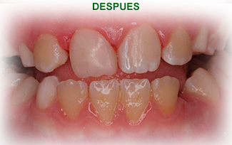 Estetica Dental Tras del tratamiento