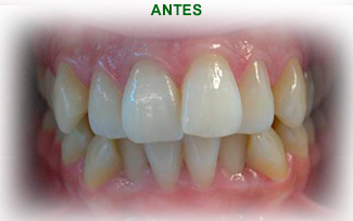 Ortodoncia Dental Antes del tratamiento