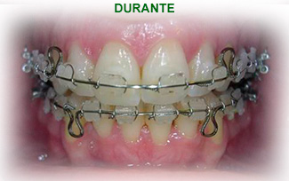 Ortodoncia Durante el tratamiento