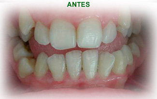 Ortodoncia Dental Antes del tratamiento