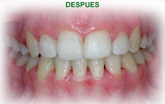 Ortodoncia Dental Tras del tratamiento