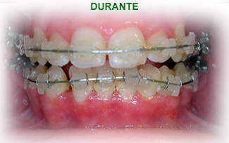 Ortodoncia Dental Durante del tratamiento